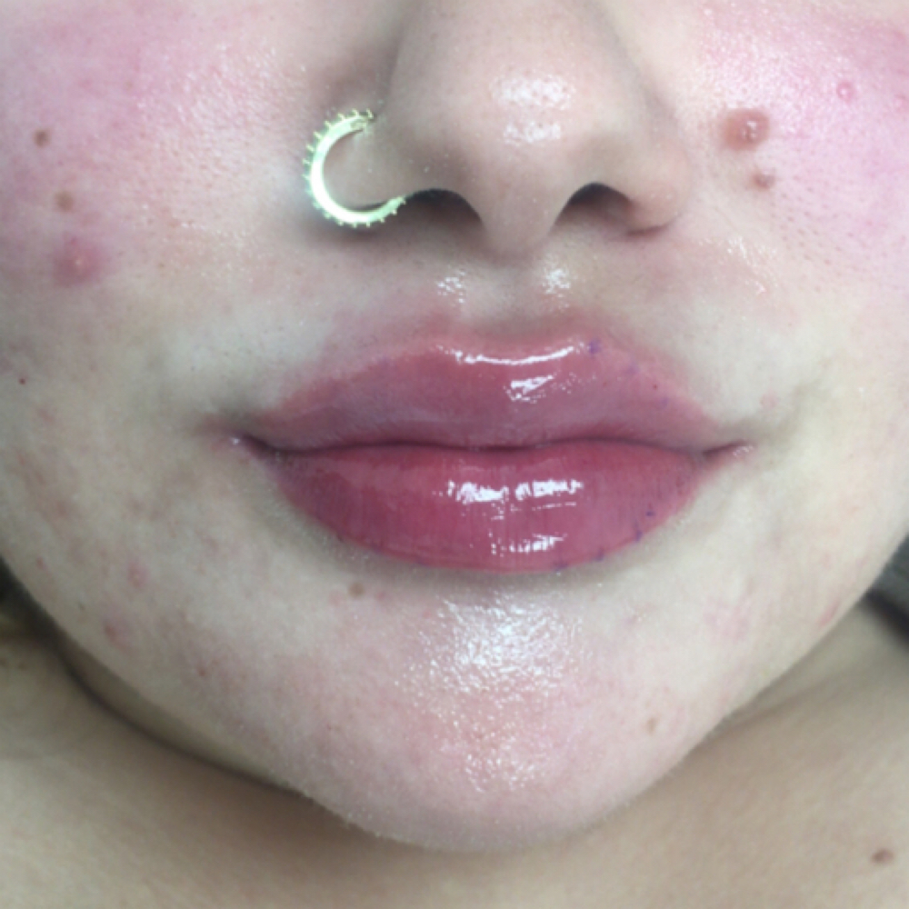Restylane Half Syring Lip Filler💋 at DopeGirlz Beauty Medical Spa /Academy in Columbus, OH