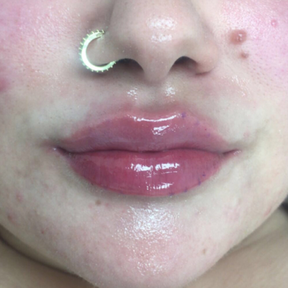 Half Syringe Lip Filler✨💋 at DopeGirlz Beauty Spa Academy in Columbus, OH