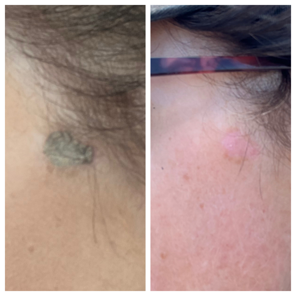 Skin Growth Removal