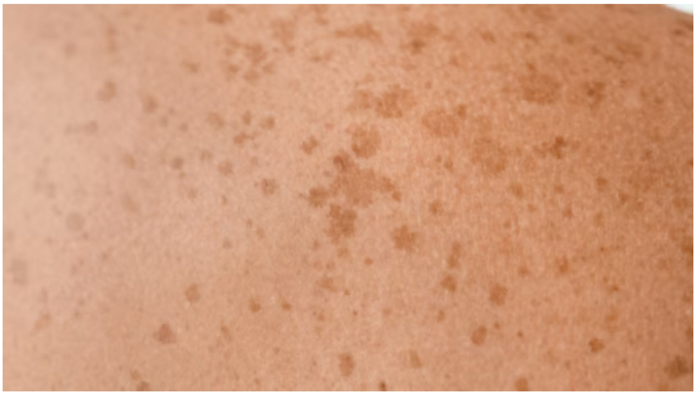 Sunspots/age Spots Treatment