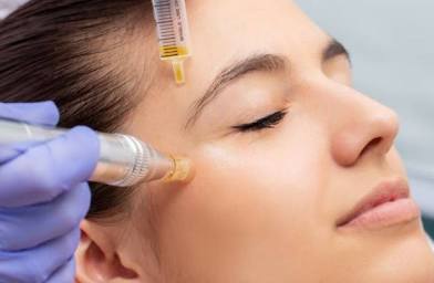 3 Sessions Of Microneedling