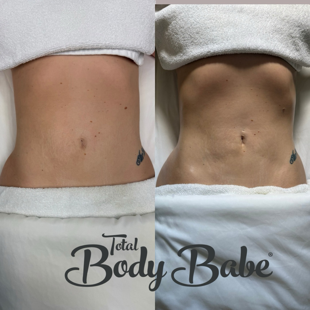 Manual Lymphatic Drainage