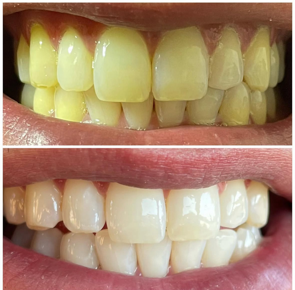 60 Minute Whitening Session
