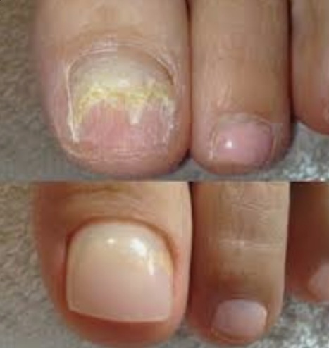 Toe Tips