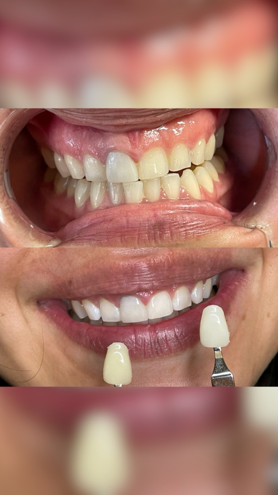 40 Minute Teeth Whitening