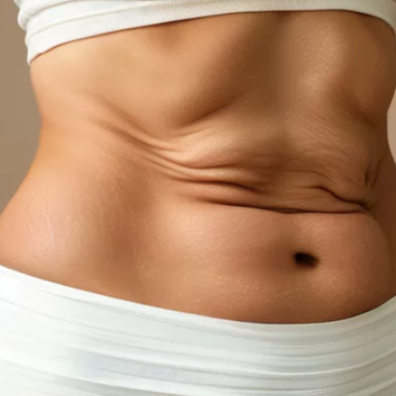 RF Skin Tightening Only at Skin Retribution in Roseville, CA