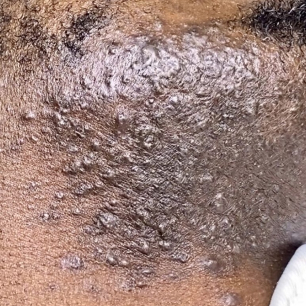 Mens Ingrown/Acne Facial at Basic and Beyond Brows in Lakewood, CA