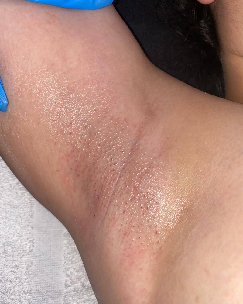 Underarm Wax
