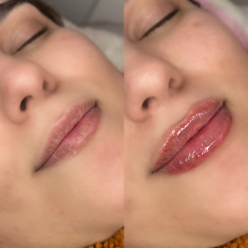Hylauron Lip Filler (1ml)