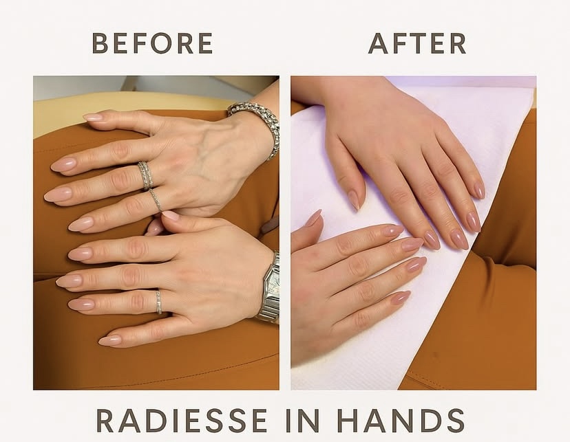 Radiesse in hands at Lavana Medspa in Edinburg, TX