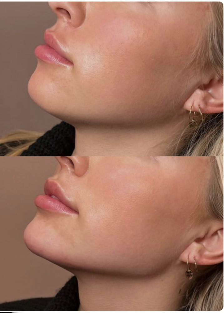 Jawline Contouring