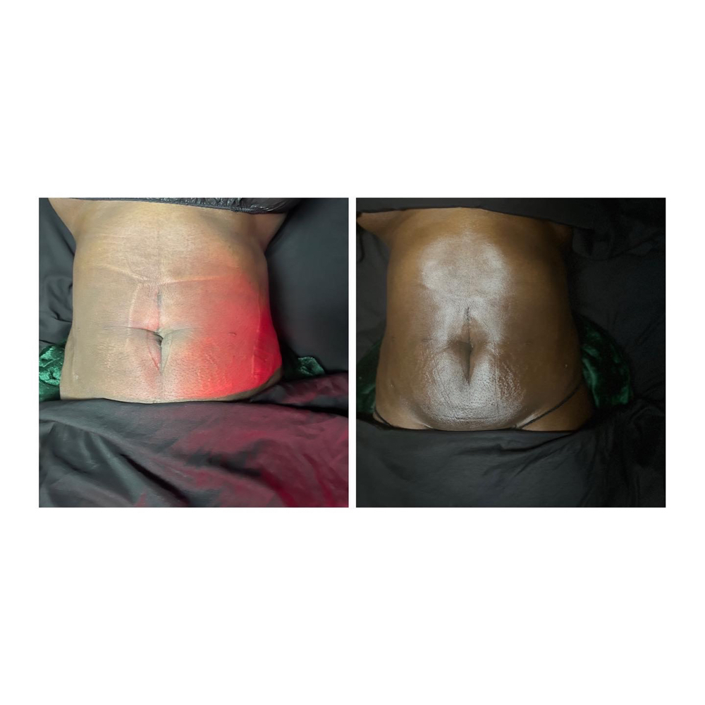 15 Manual Lymphatic Drainage at Wholistic Recovery & Wellness Spa in Snellville, GA