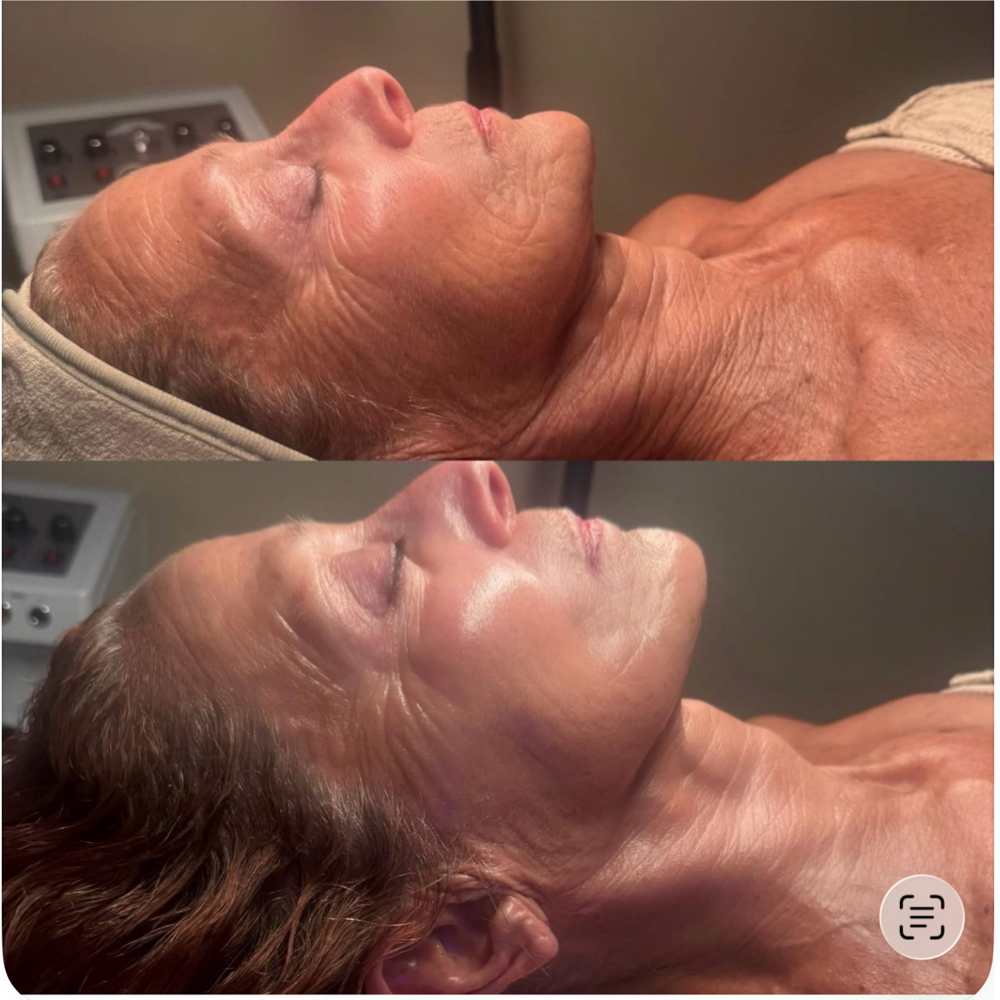 Lux Lift (W/O the Botox)Facial at Inspired Beauty Lounge in Frisco, TX