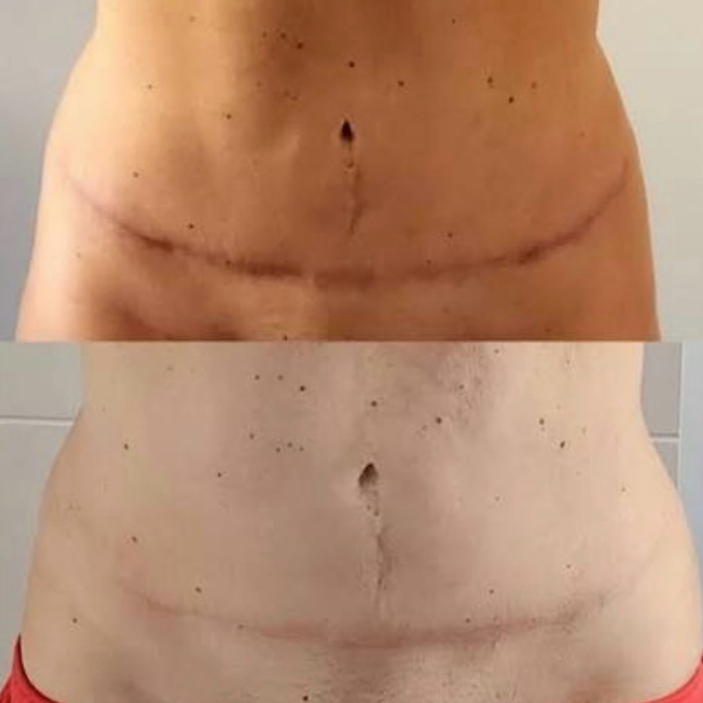TUMMY TUCK SCAR CAMOUFLAGE at BEAUTY LAB COLLECTIVE in Miami, FL