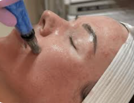 Microneedling With Rejuvapen