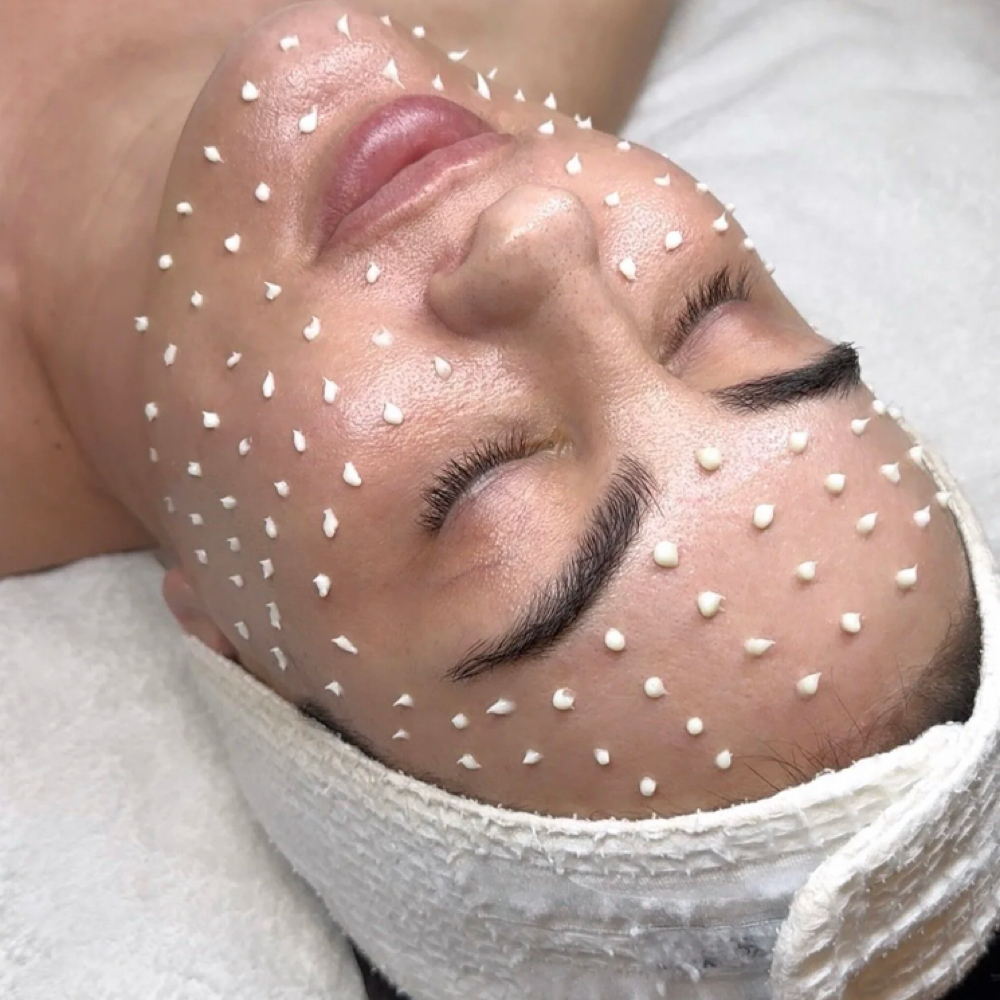 Miracle Tox-Microneedling (Beginner at Kairopractic Skin in San Bruno, CA