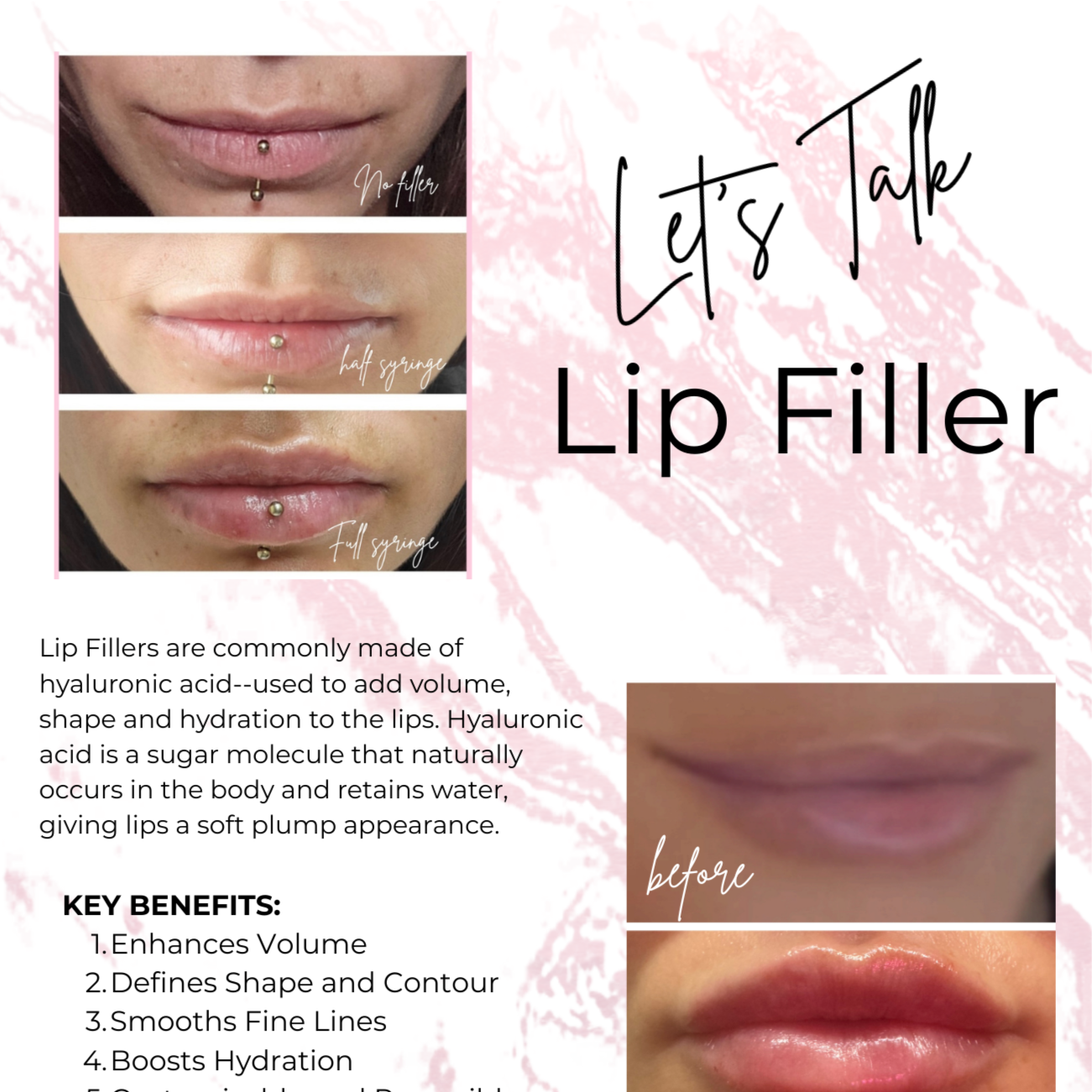 Lip Filler at Leann Renee Aesthetics in St. Peter's, MO