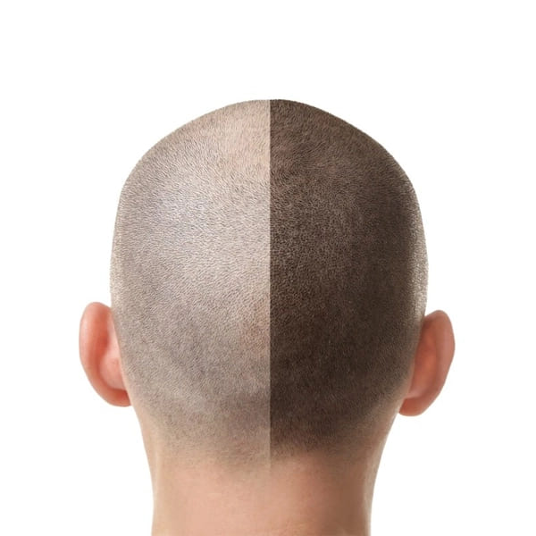 Scalp Micropigmentation