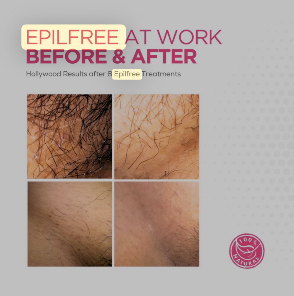 Epilfree Hair Removal at Finesse Studio in Grand Junction, CO