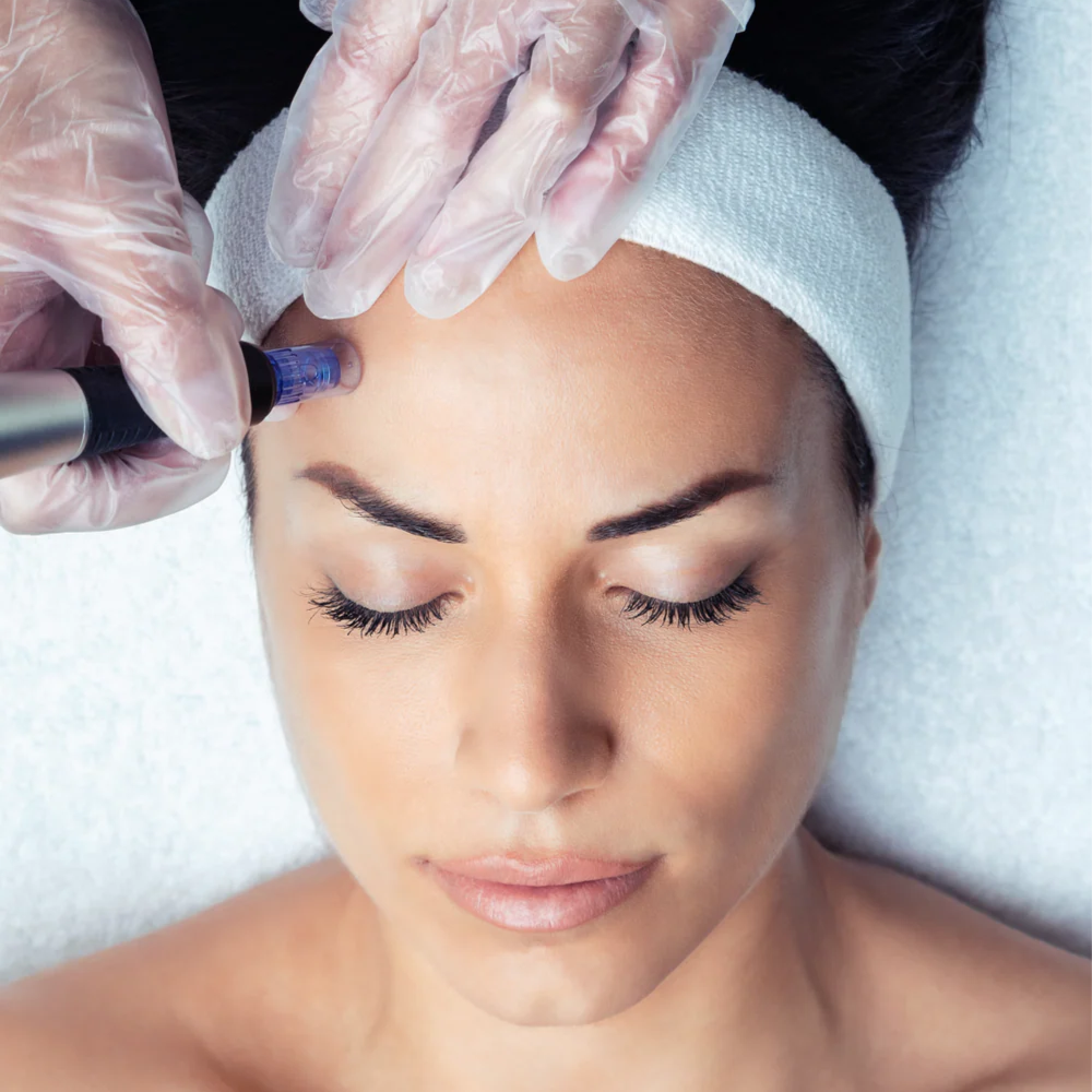 MICRONEEDLING + Regenerative cells at GOLD SKIN SPA AND BEAUTY in MCALLENT, TX