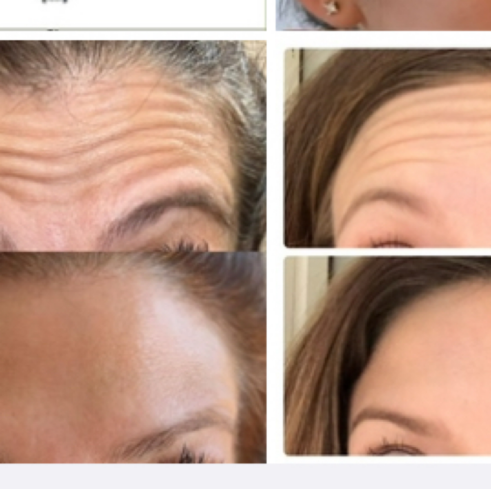 Botox- Forehead Only at Groomsology MedSpa in Mt Orab, OH