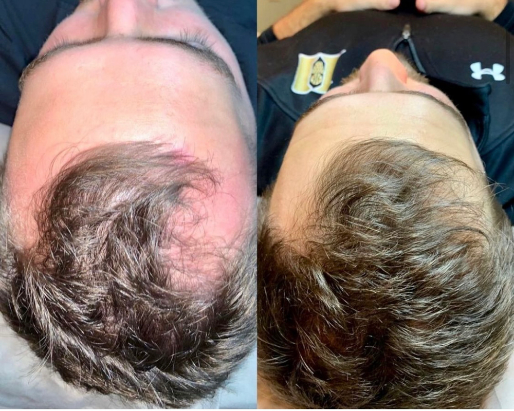 Procell Hair Restration Package X 4