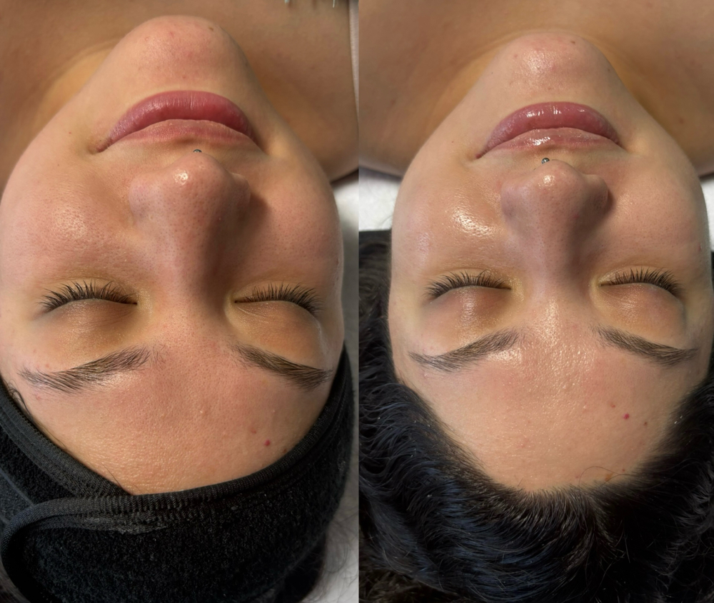 Hydro Deluxe + Dermaplaning