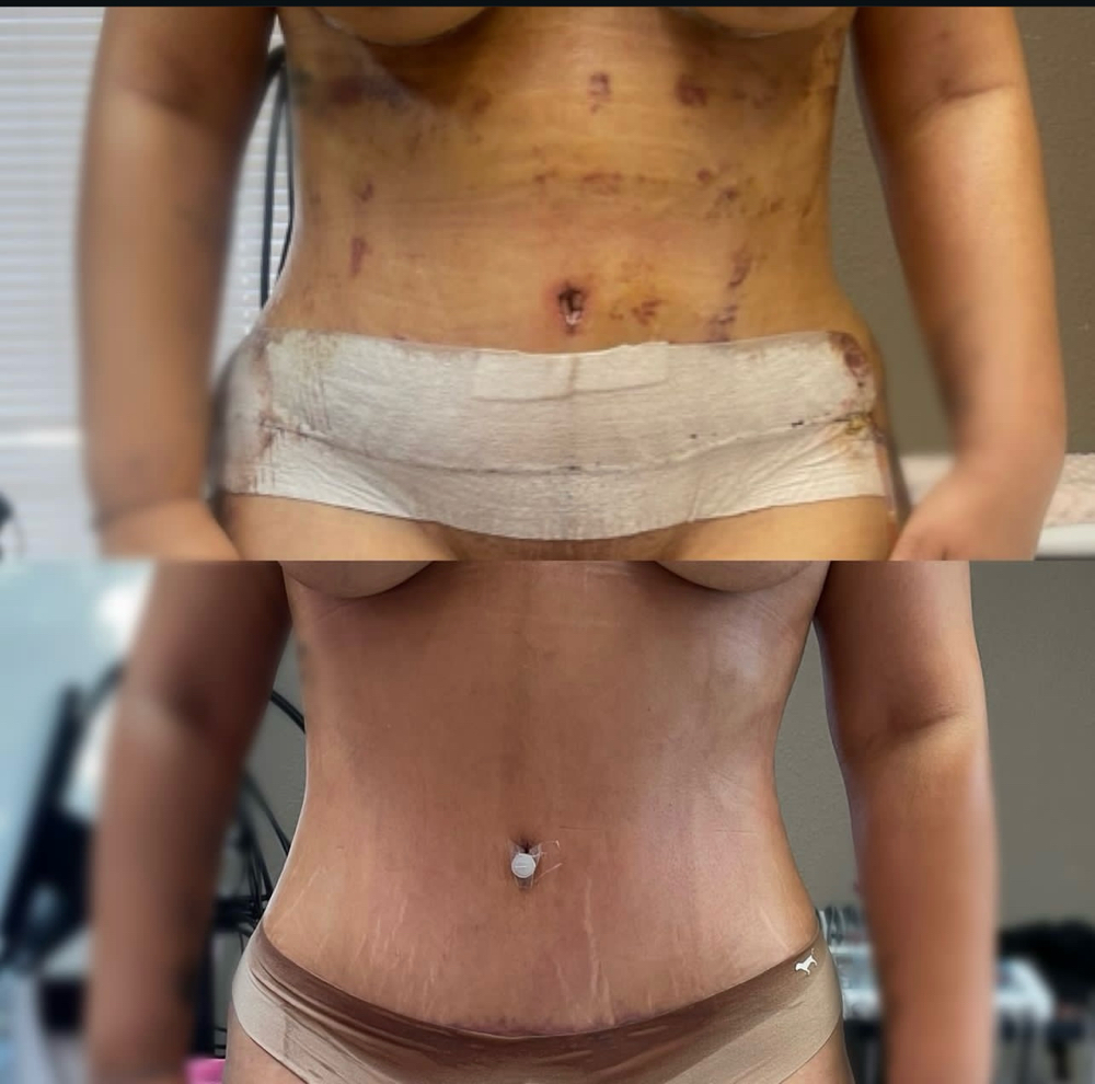 Post Op (Less than 4 weeks healed)