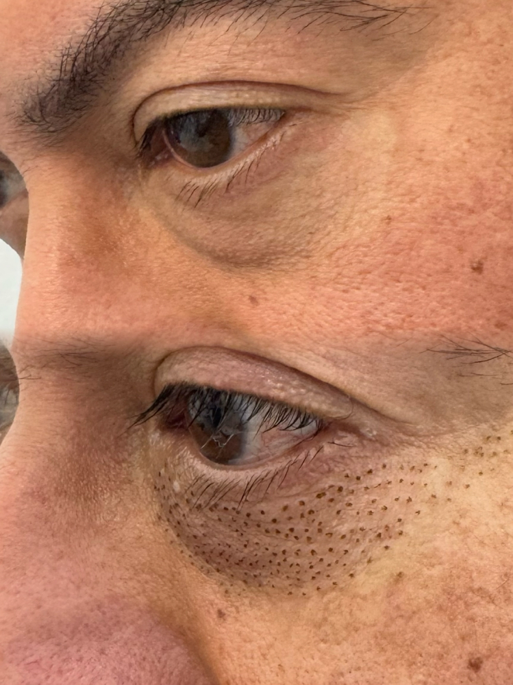 Under Eyelids Rejuvenation