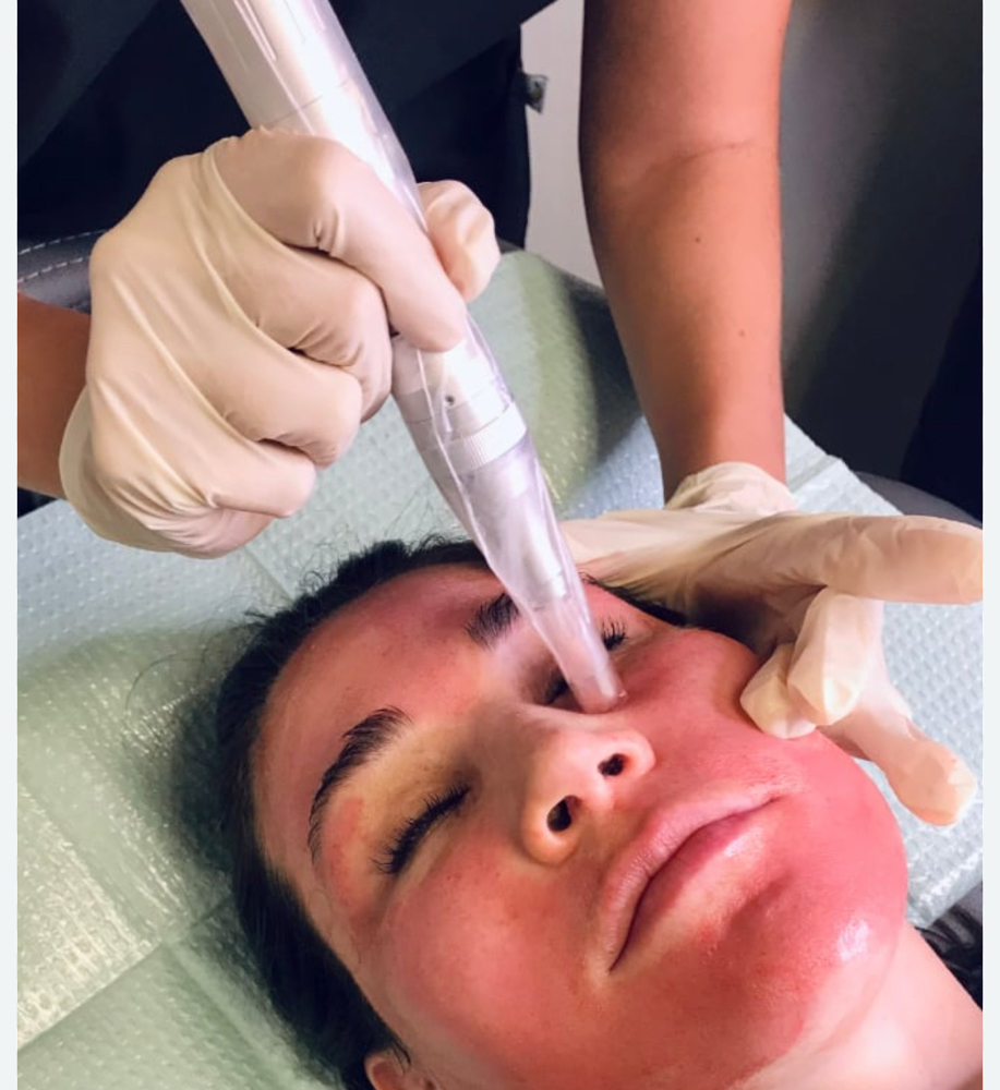 Microneedling