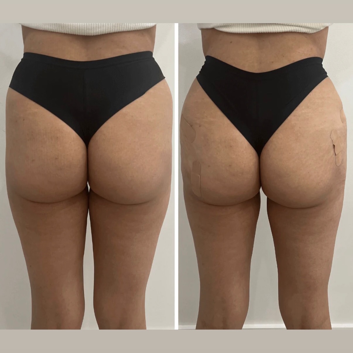 Sculpture Bum Enhancement at Gold Stone Beauty in mcallen, TX