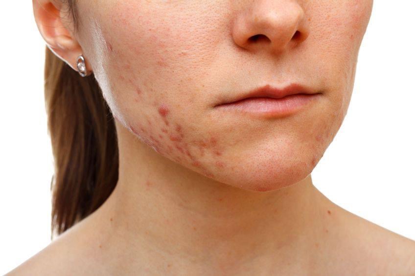 Adult Acne Skin Treatment