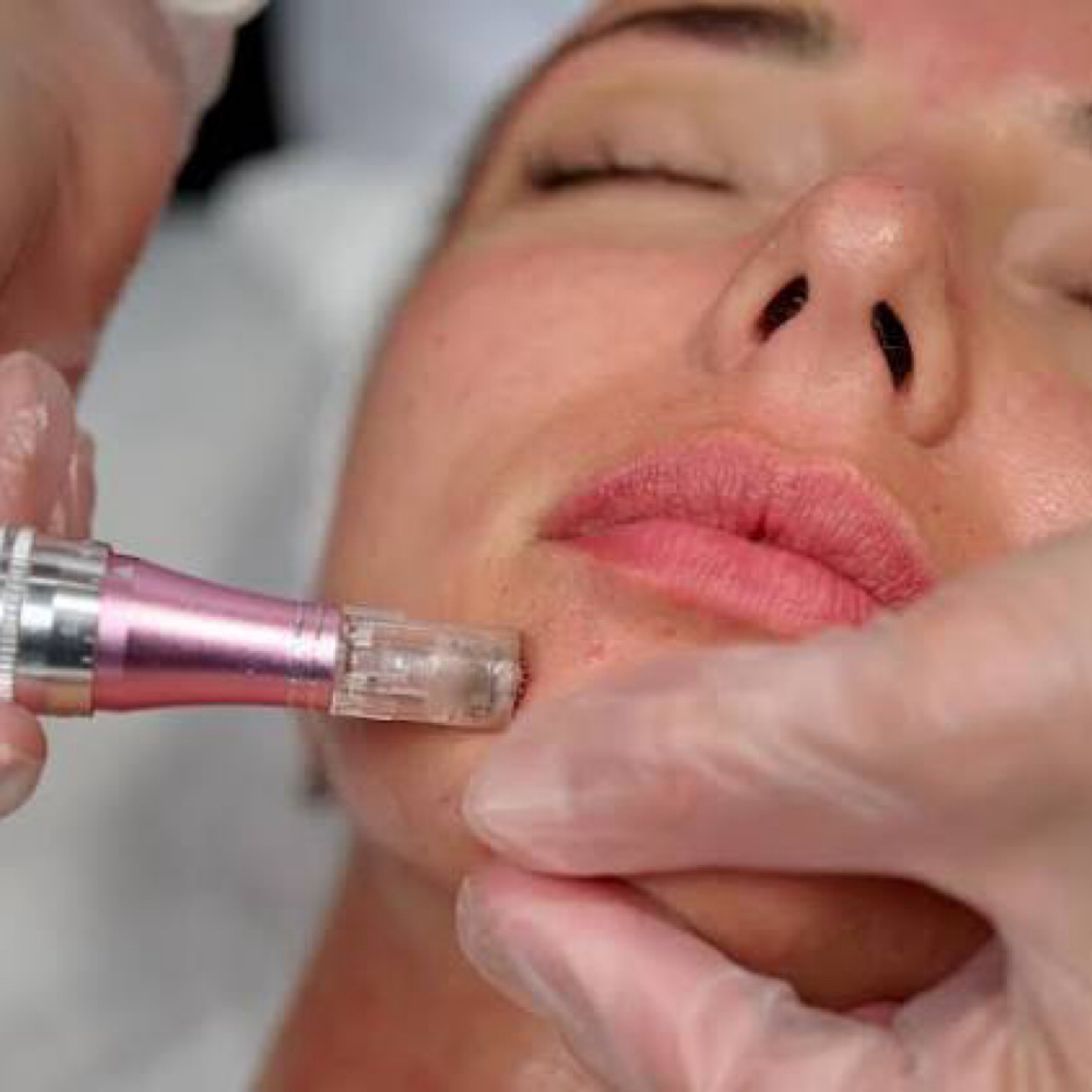 Exosomes + PRN Facial