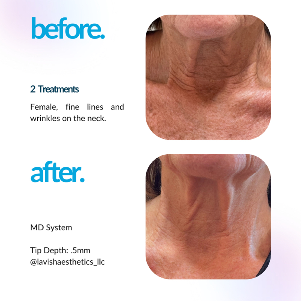 Procell Neck Add-On at Mane Focus Hair Salon in Savannah, GA