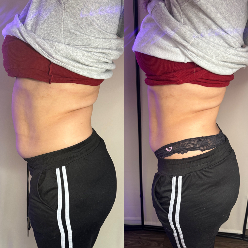 Body Contouring + Booty Enhancemet