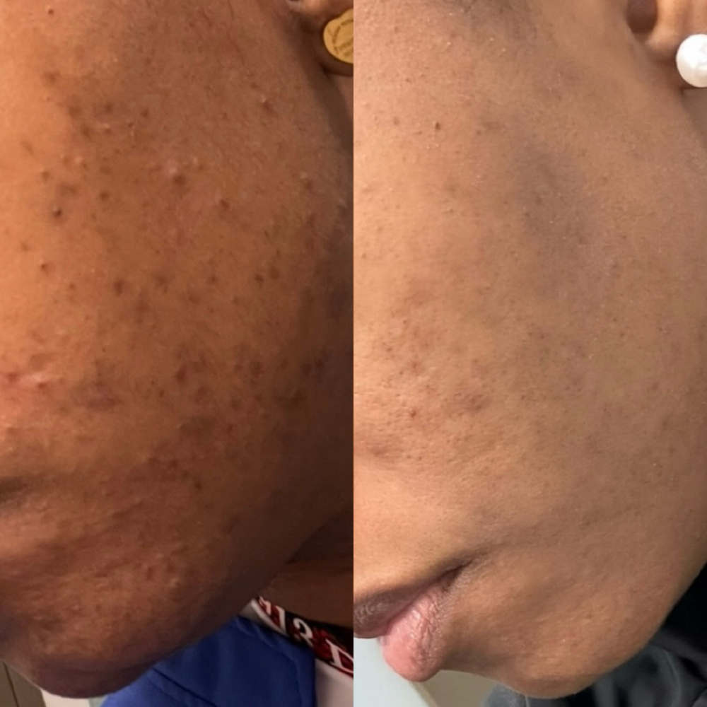 Herbal Peel Consultation at Bree The Esti in Columbia, SC