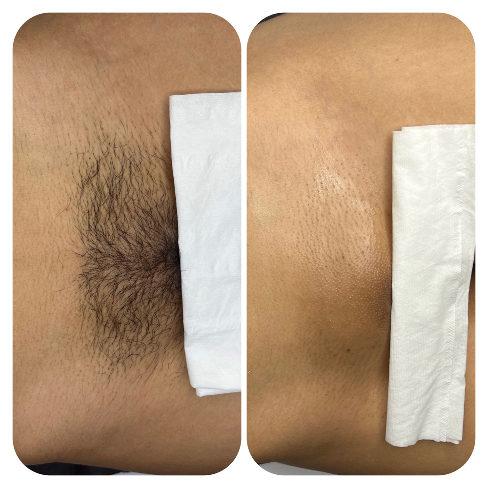 Brazilian Wax