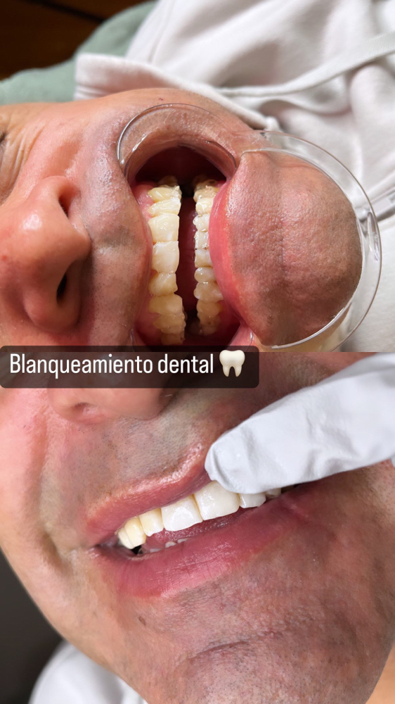 Teeth Whitening/Blanqueamiento Dent