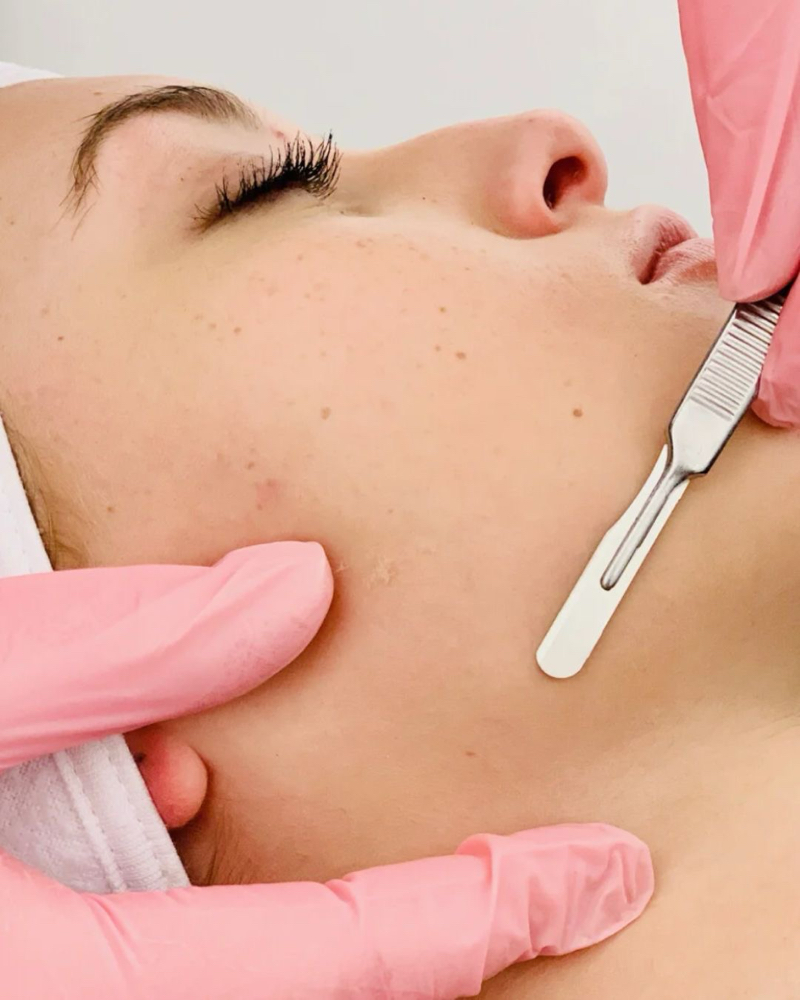 Dermaplane Facial