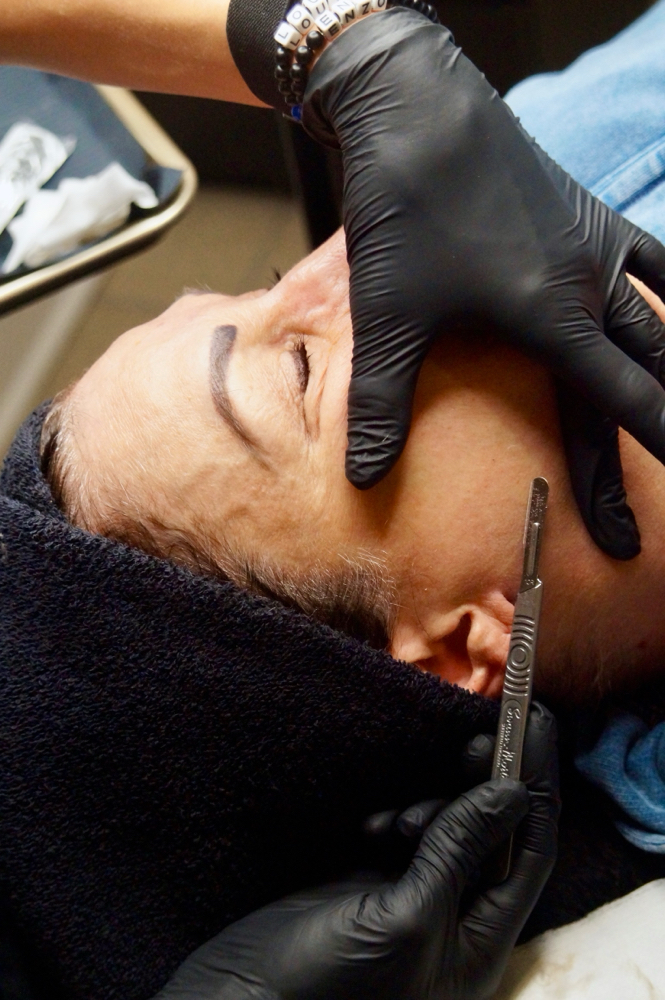 Dermaplaning