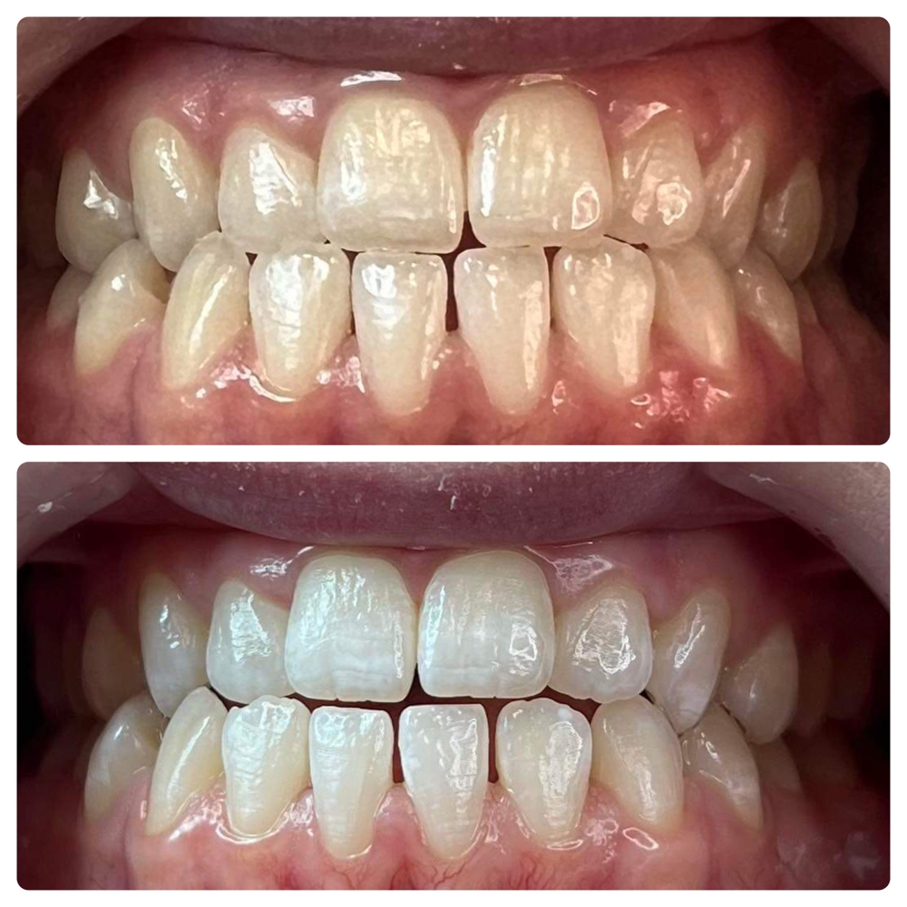 Professional Teeth Whitening