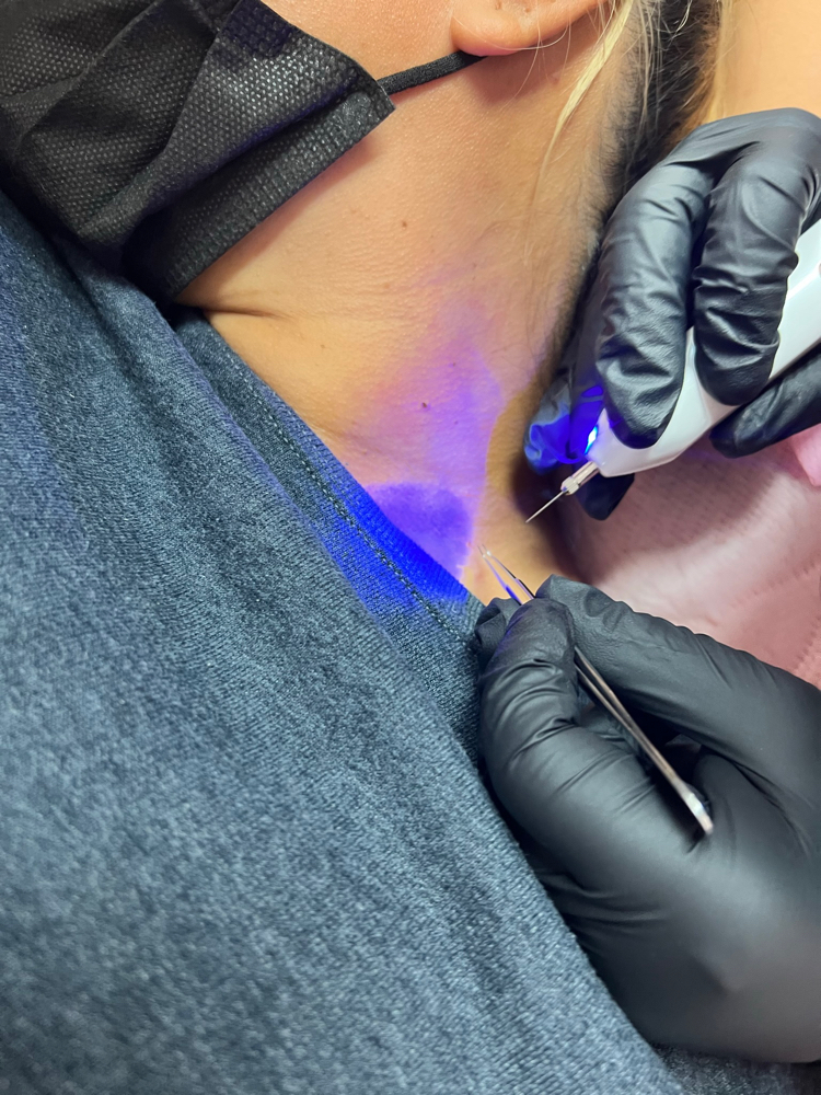 Skin Tag Removal (each)