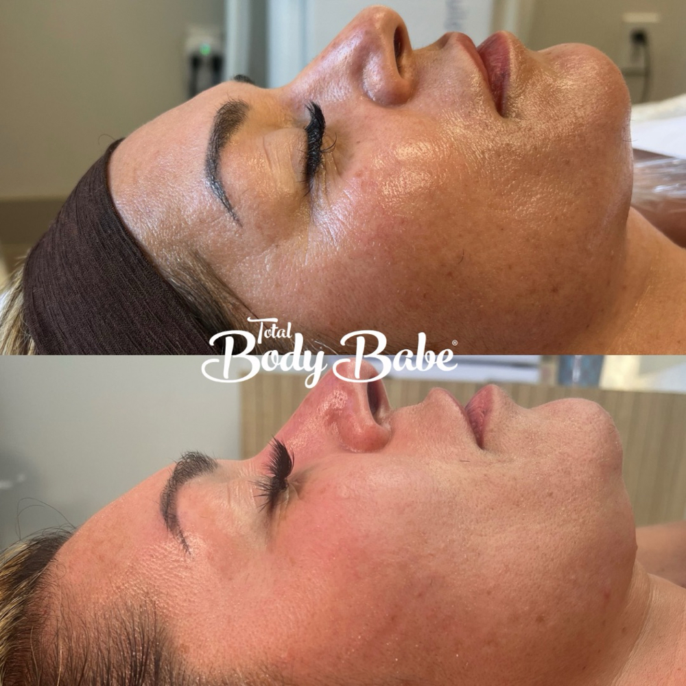 Neck & Face Sculpting