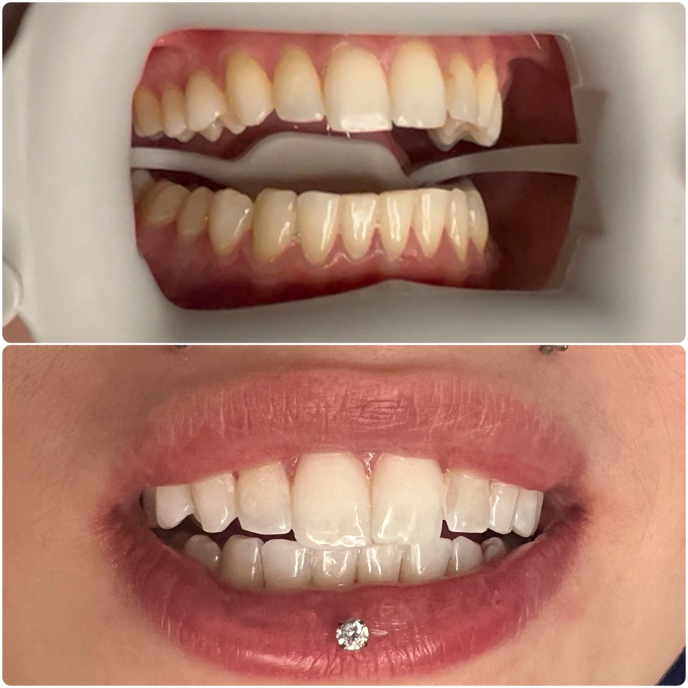 Ultra Sonic Teeth Whitening