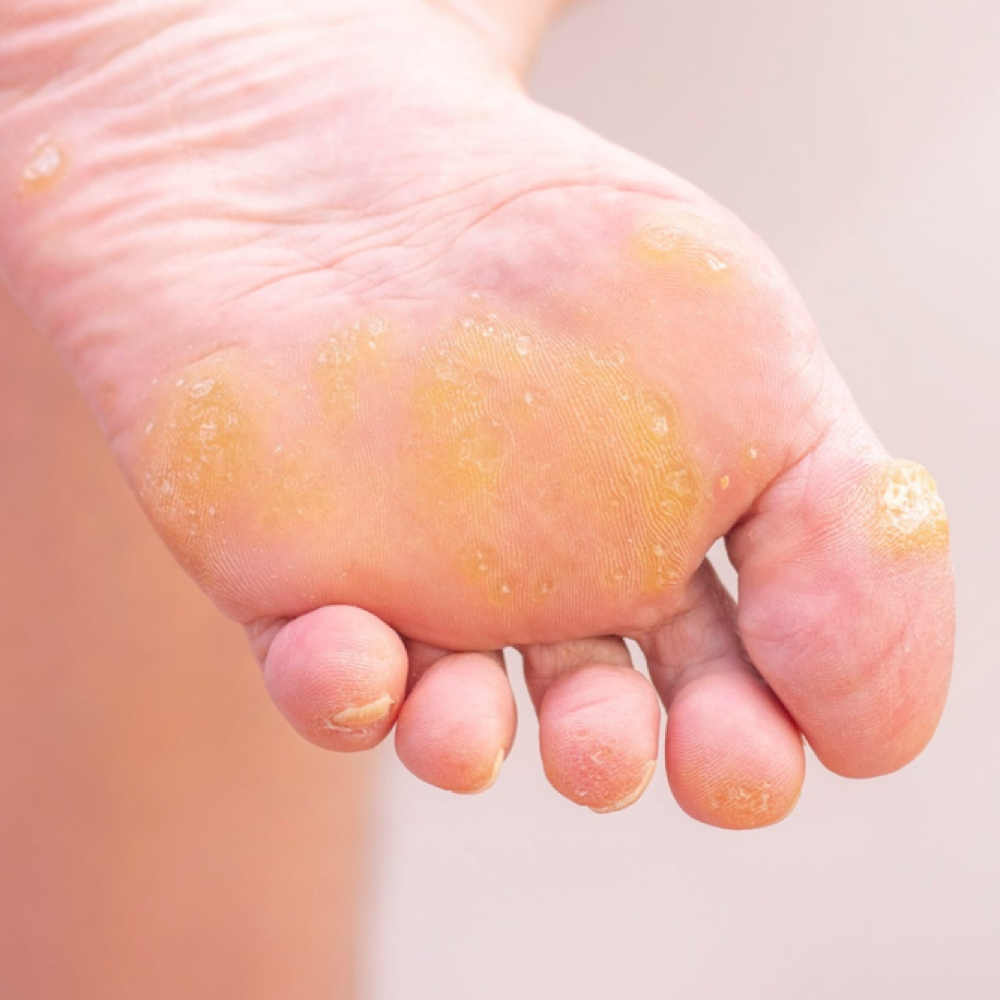 Resmocion De Callosidad at Rut Albornoz/Foot Care37 in Rhode Island, RI