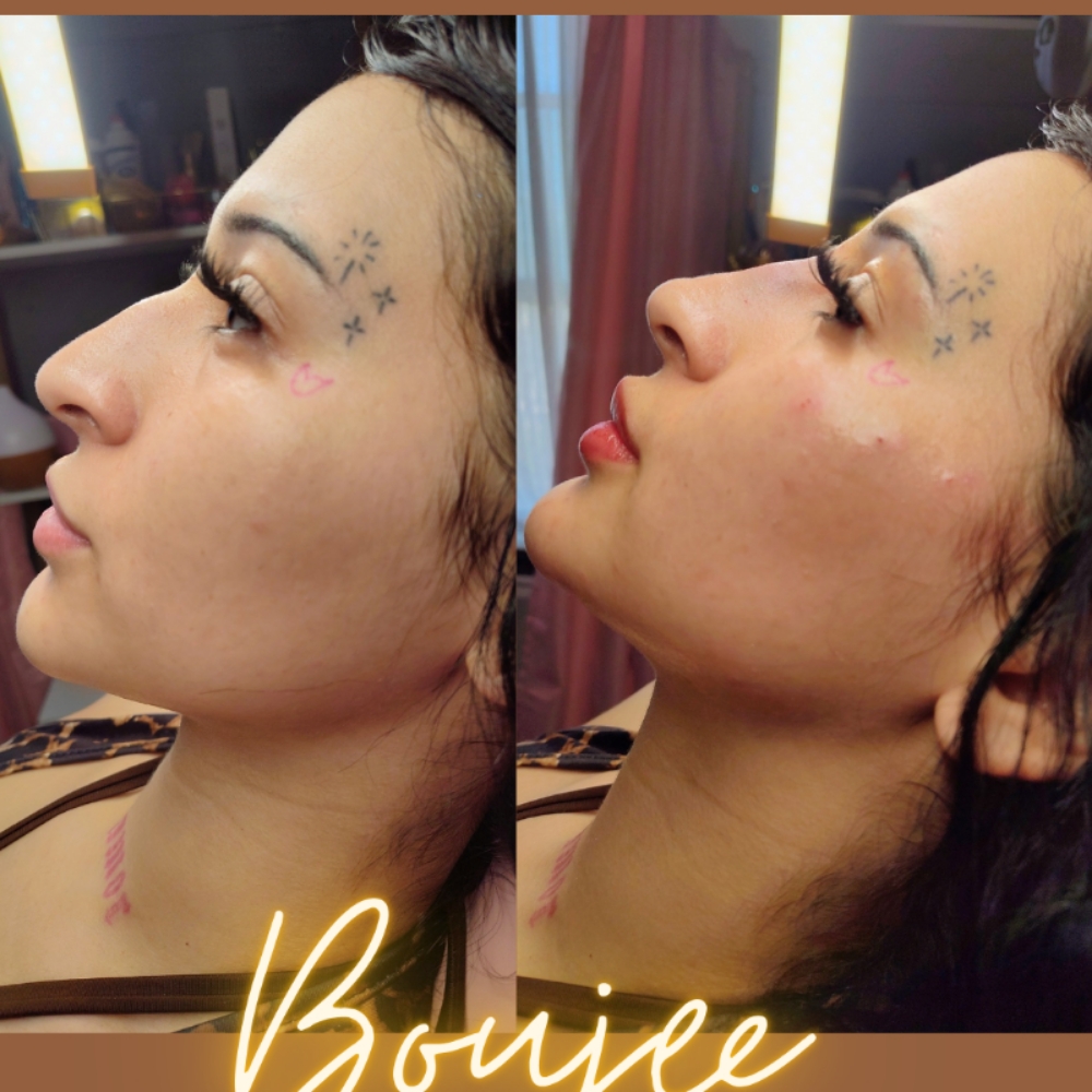 Facial BALANCING ✨💉 at Boujee Asthetics ✨ in Tucson, AZ