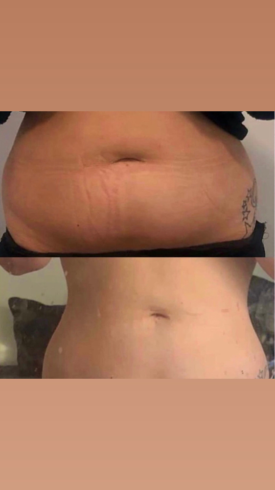 Ultrasonic Cavitation Slimming