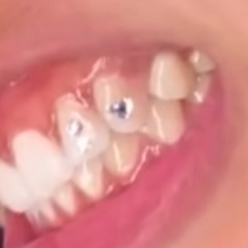 Tooth Gems at Just Jane Aesthetics in Essex, MD