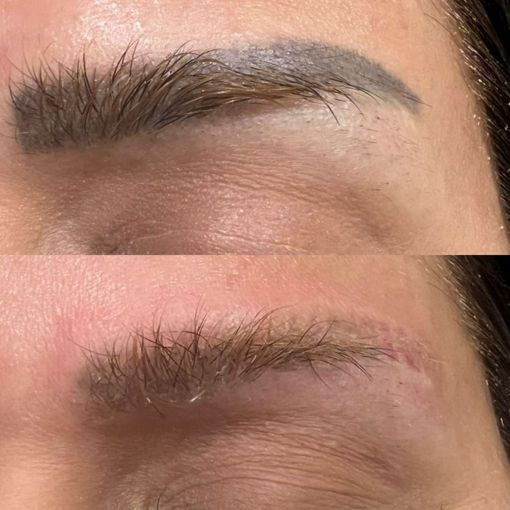 Eyebrows Removal