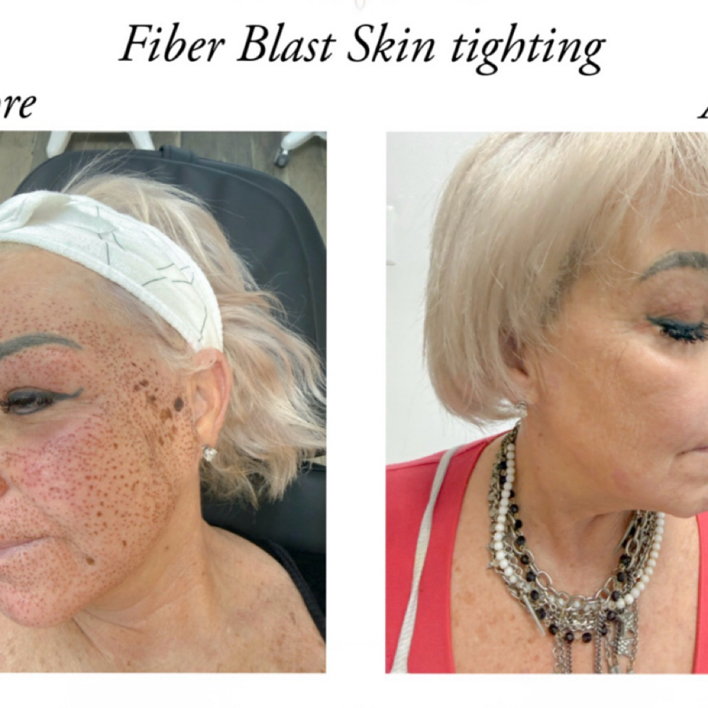 Fibroblast Plasma-Full Face at Ush Beauty & Wellness Lounge in North Potomac, MD
